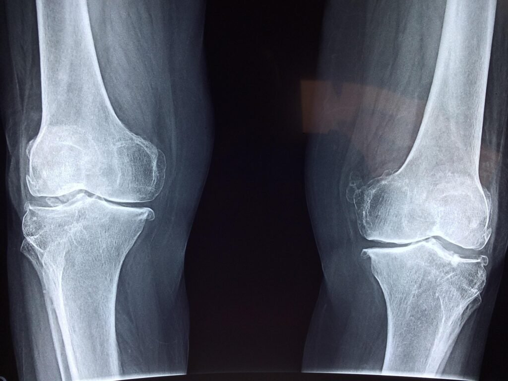 X-ray images displaying knee bones, highlighting cartilage and the effects of a steroid injection